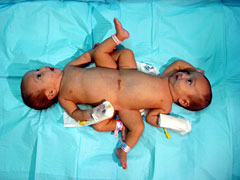 Filipino Conjoined Twins Ready For Operation
